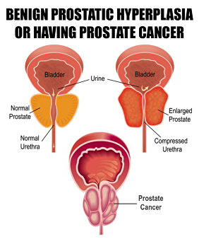 benign or cancerous prostate