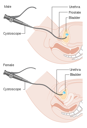 flexible cystoscopy